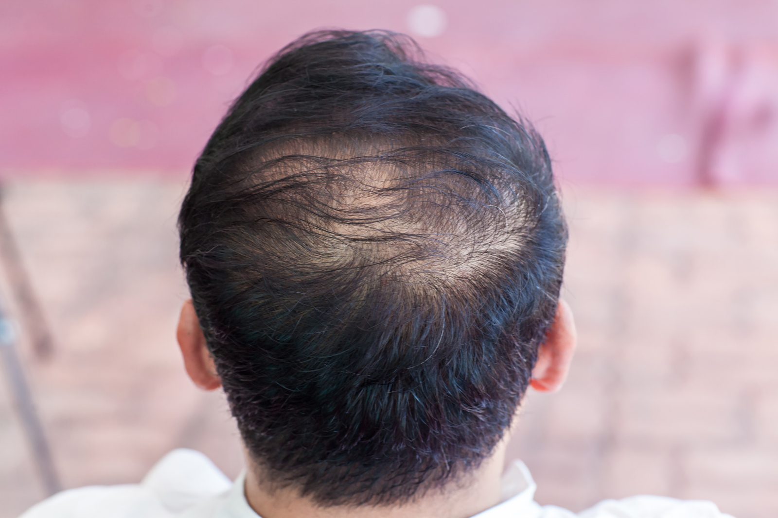 Close up hair loss, thinning hair and scalp issue. hair loss treatment.head with loss symptoms. Bald treatment. Bald hair of male heredity